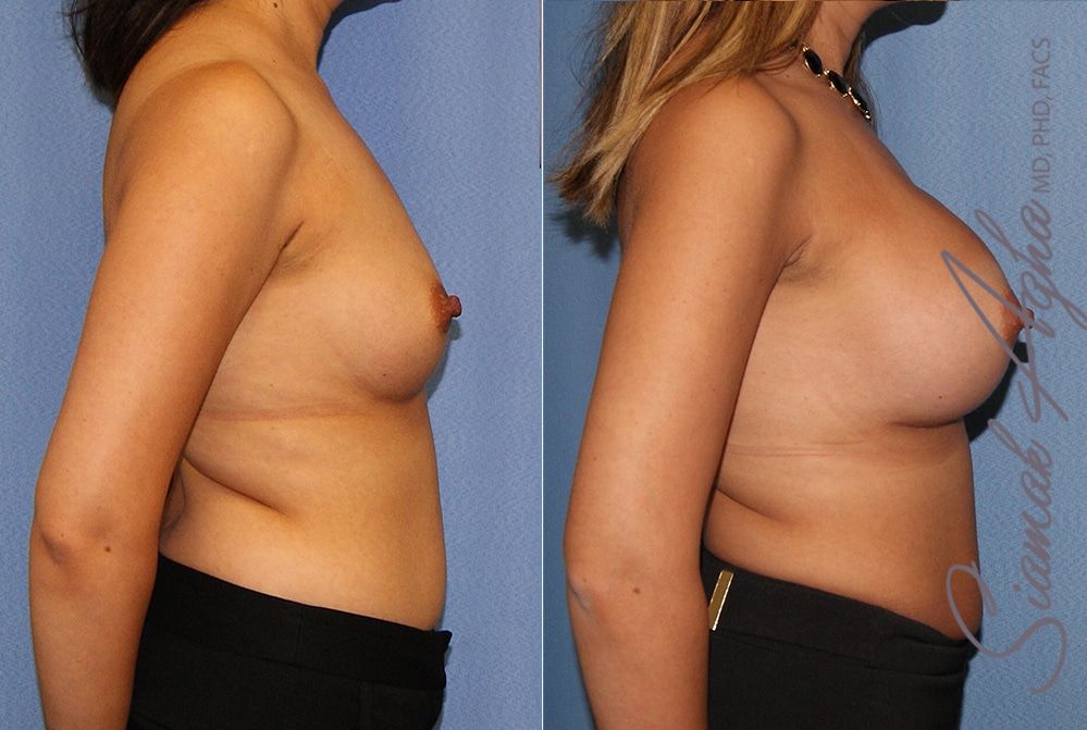 Breast Augmentation Before & After