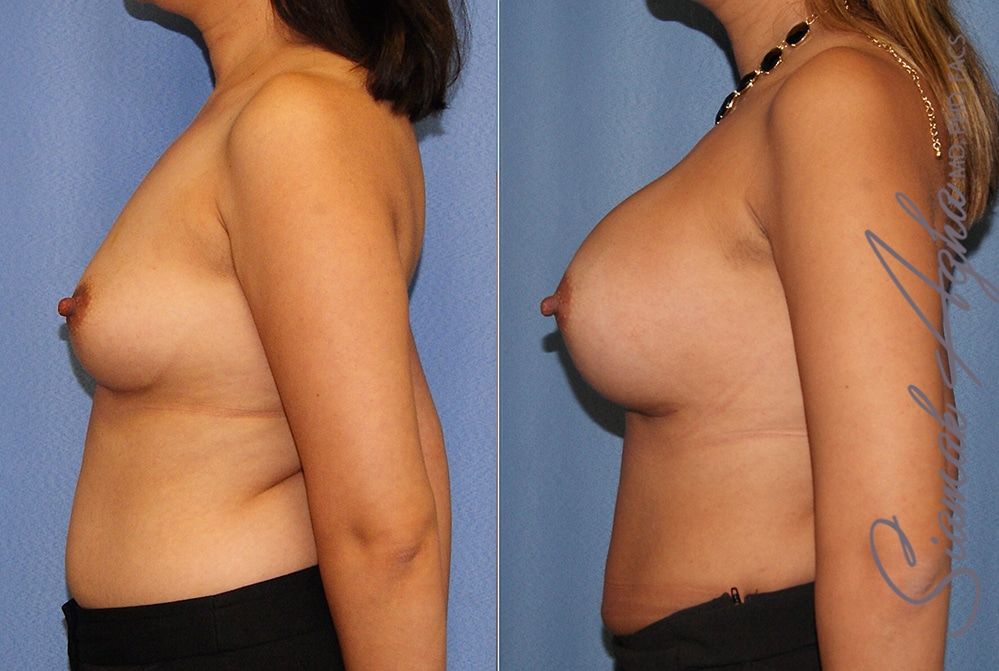 Breast Augmentation Before & After
