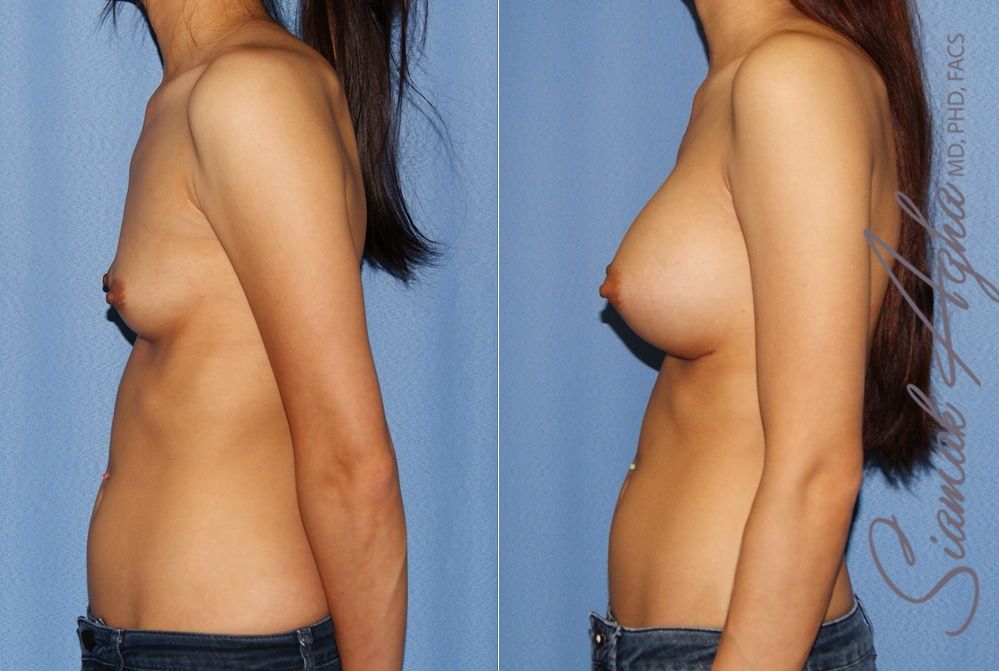 Breast Augmentation Before & After