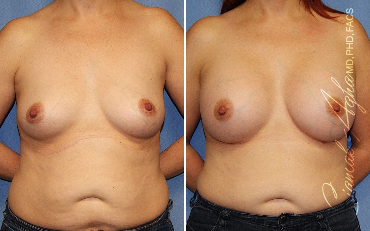 Breast Augmentation Before & After