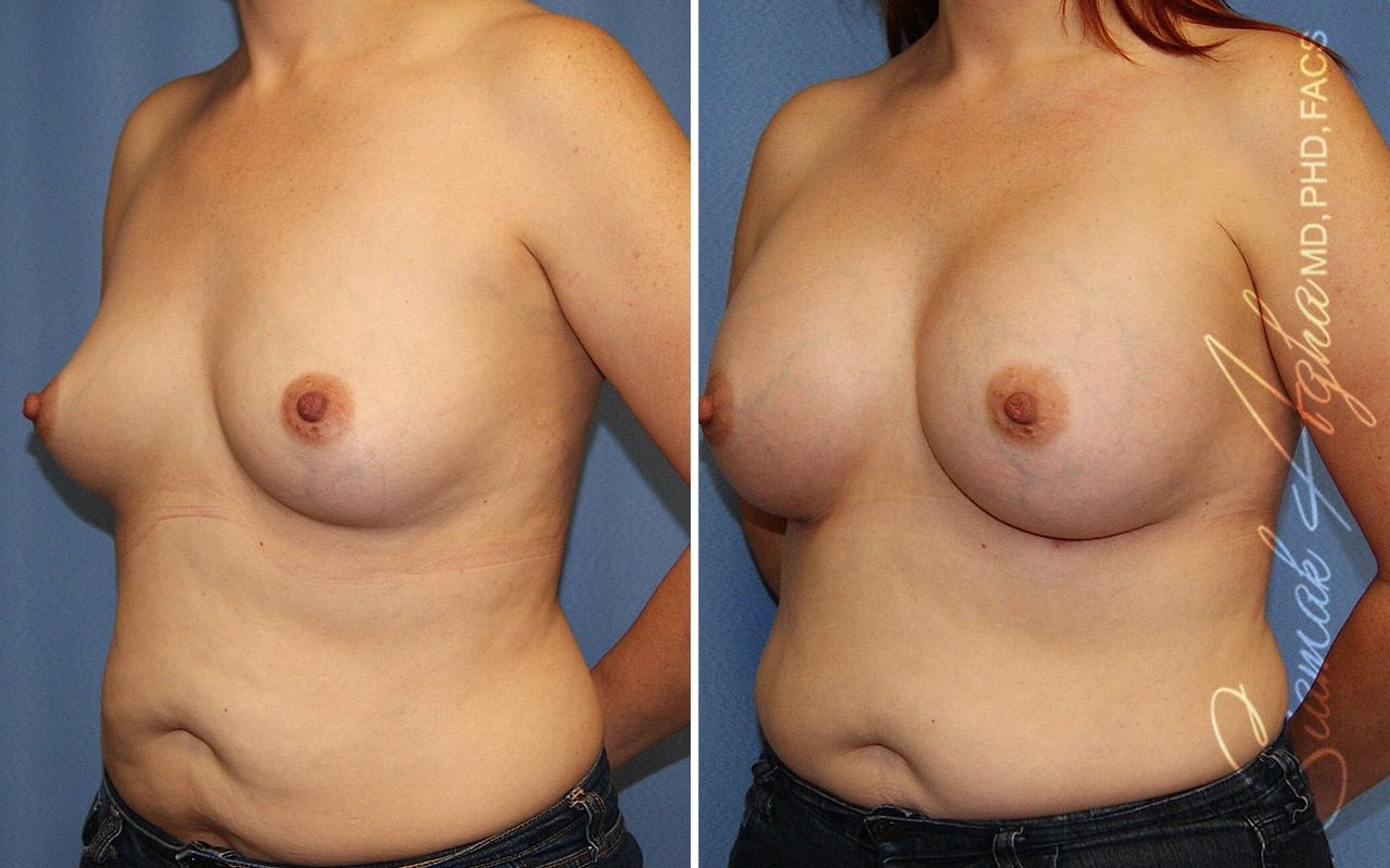 Breast Augmentation Before & After
