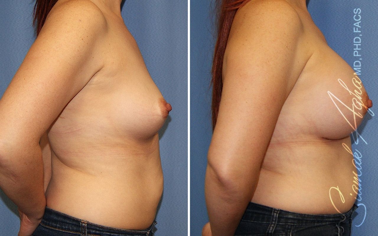 Breast Augmentation Before & After