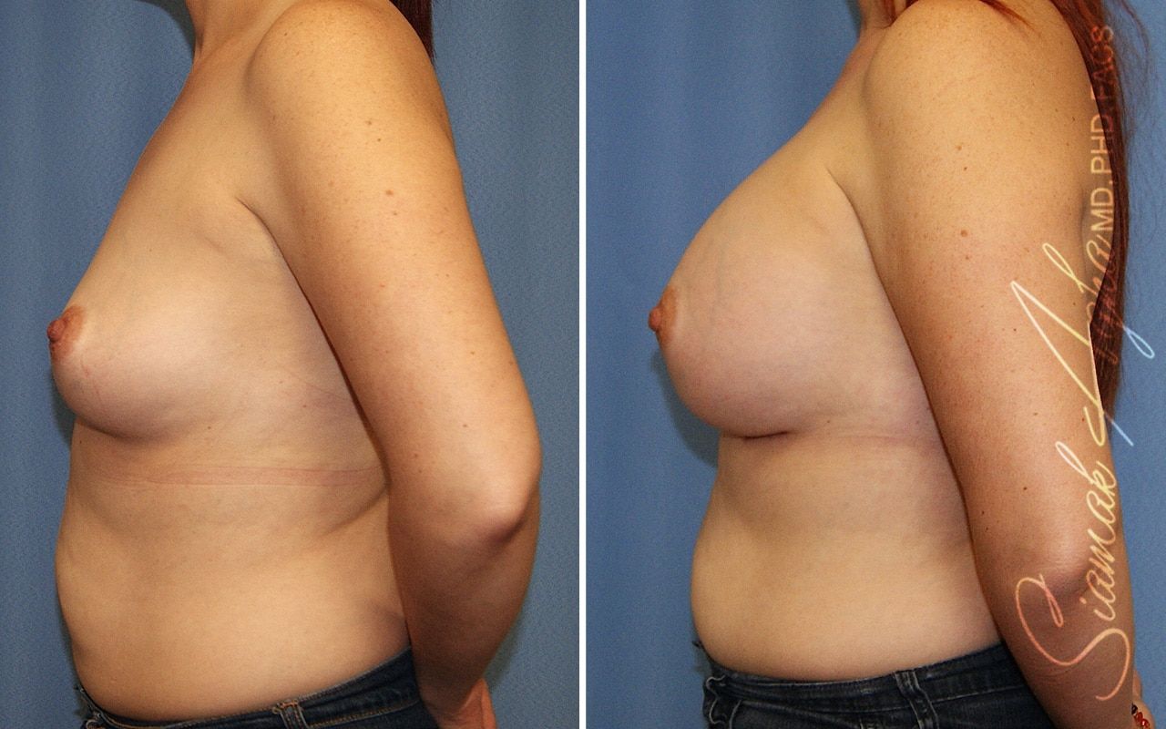 Breast Augmentation Before & After