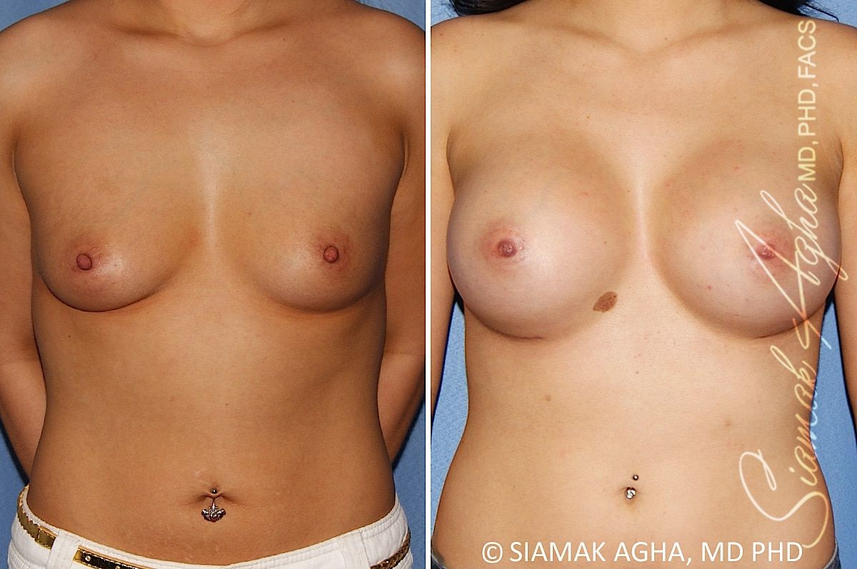 Breast Augmentation Before & After