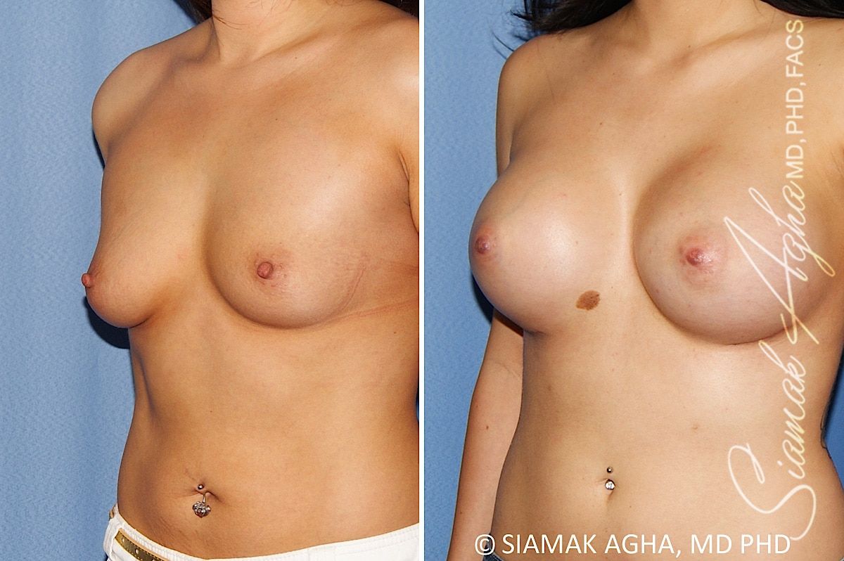 Breast Augmentation Before & After