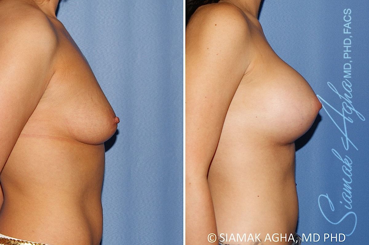 Breast Augmentation Before & After