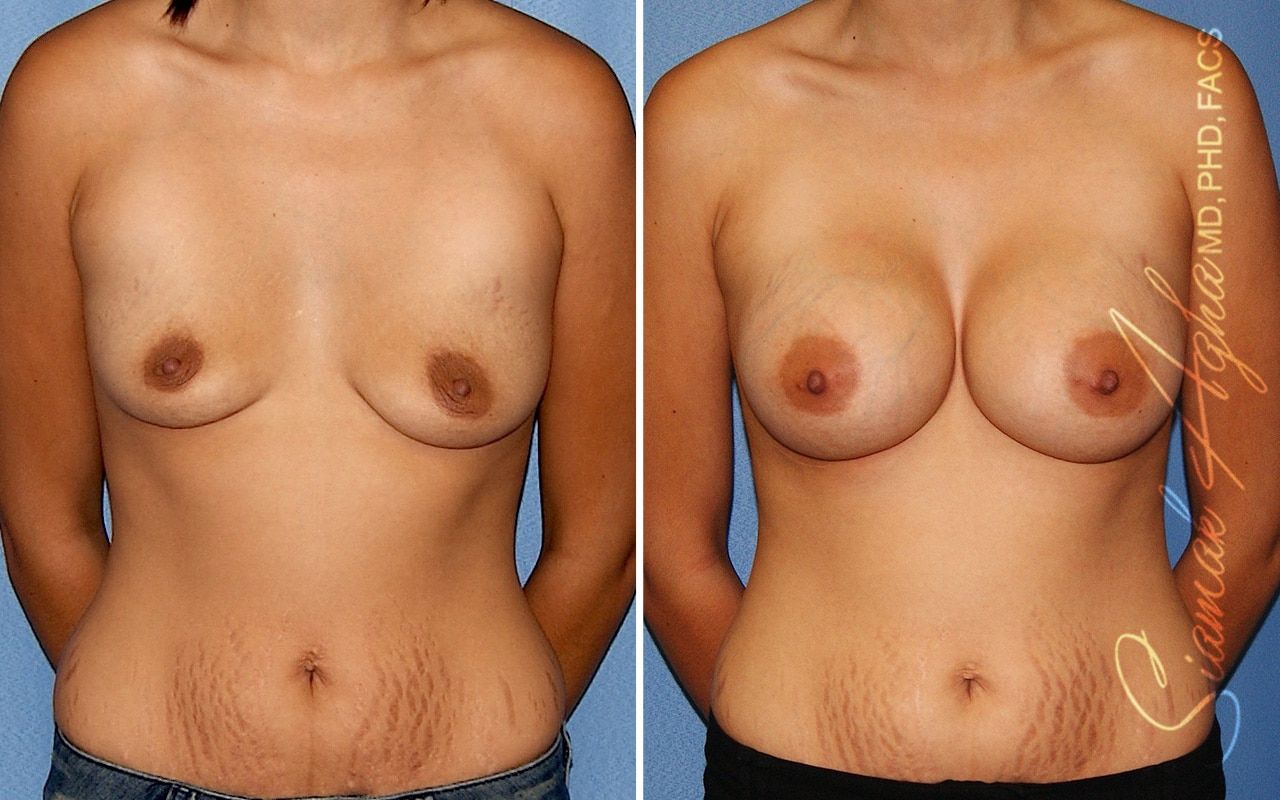 Breast Augmentation Before & After