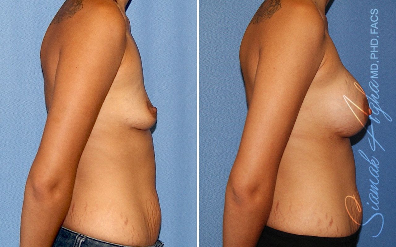 Breast Augmentation Before & After