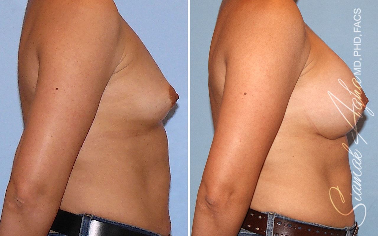 Breast Augmentation Before & After