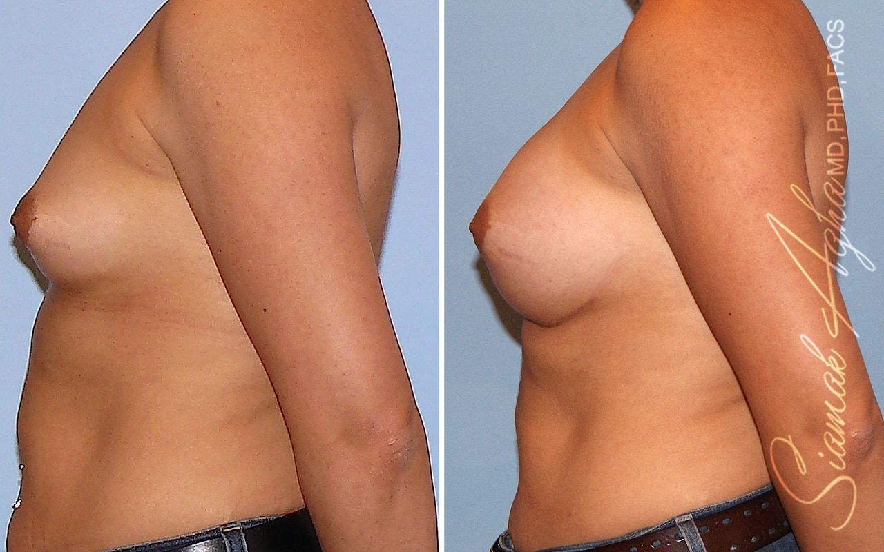 Breast Augmentation Before & After