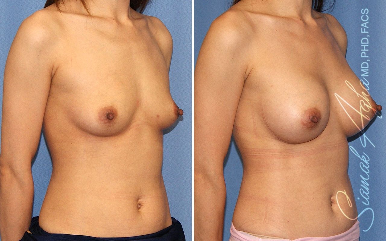 Breast Augmentation Before & After