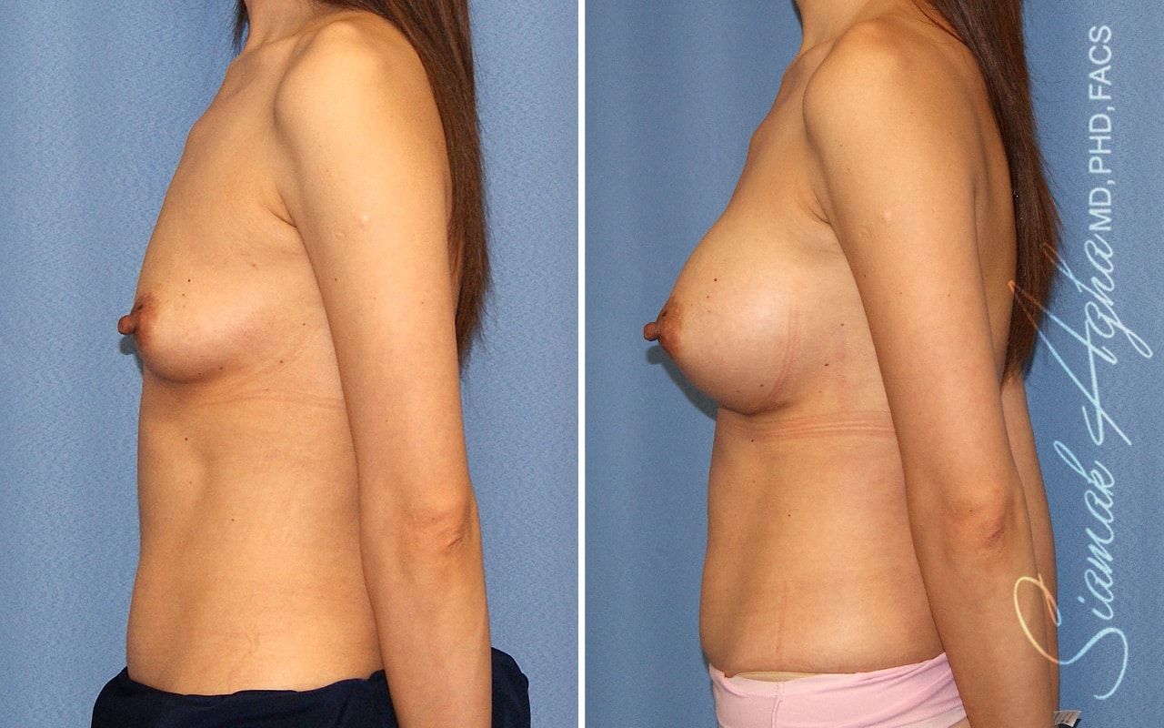 Breast Augmentation Before & After