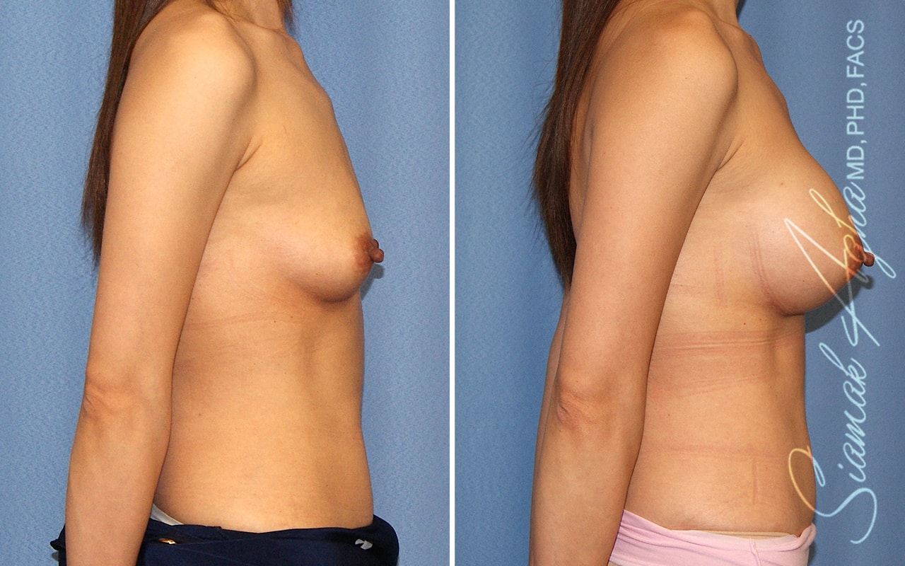 Breast Augmentation Before & After