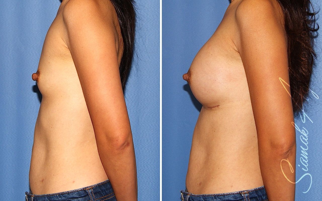 Breast Augmentation Before & After