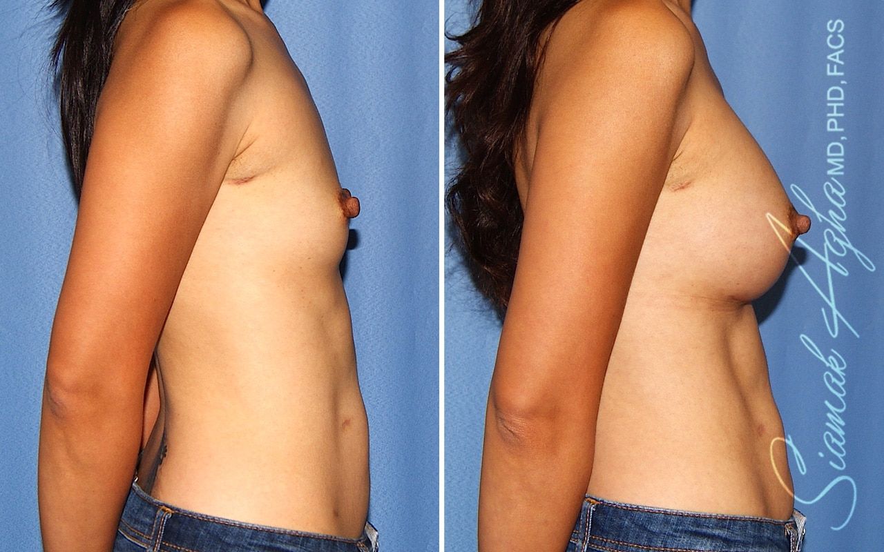 Breast Augmentation Before & After