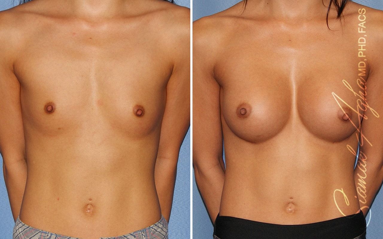 Breast Augmentation Before & After
