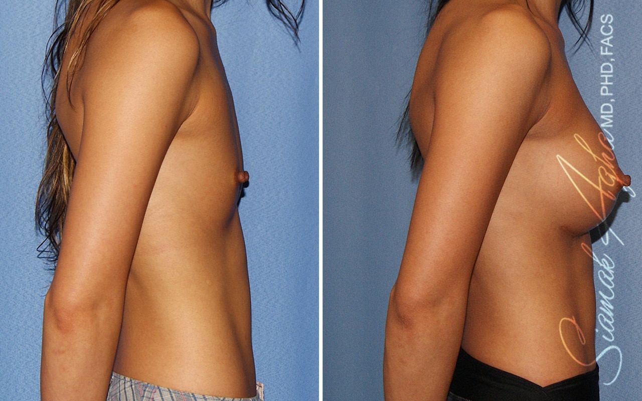 Breast Augmentation Before & After