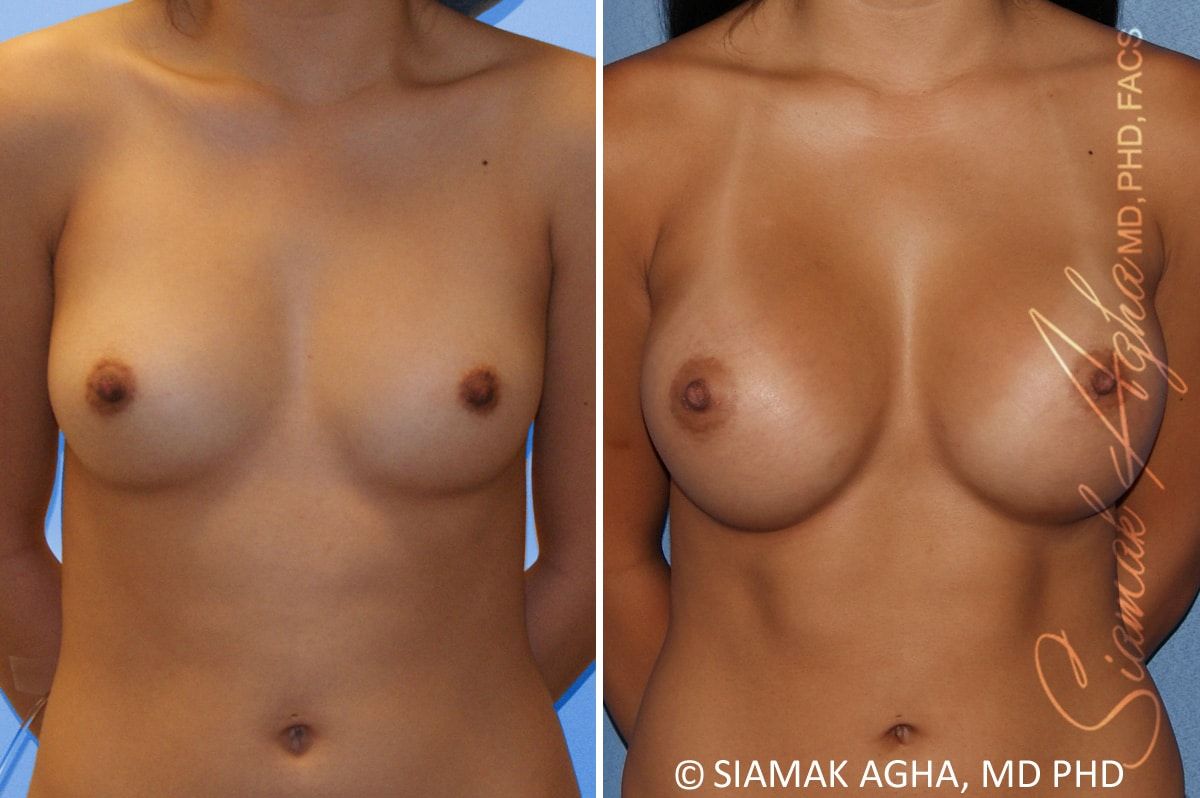 Breast Augmentation Before & After