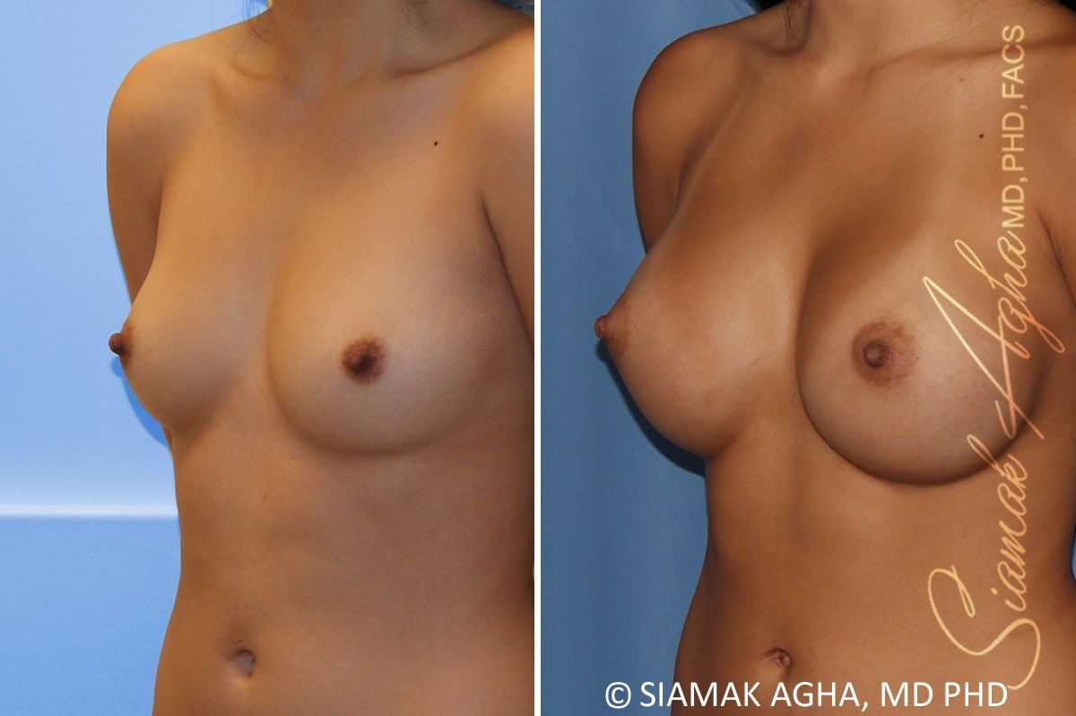 Breast Augmentation Before & After