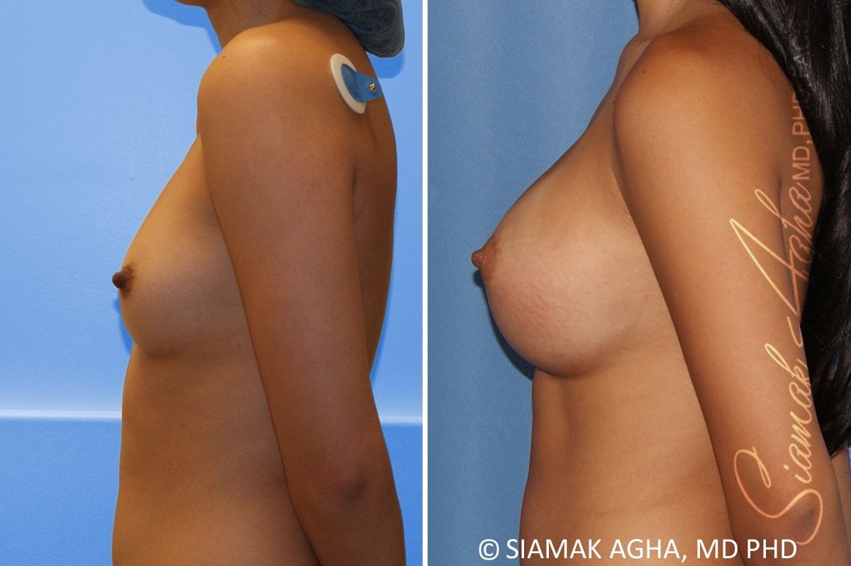 Breast Augmentation Before & After