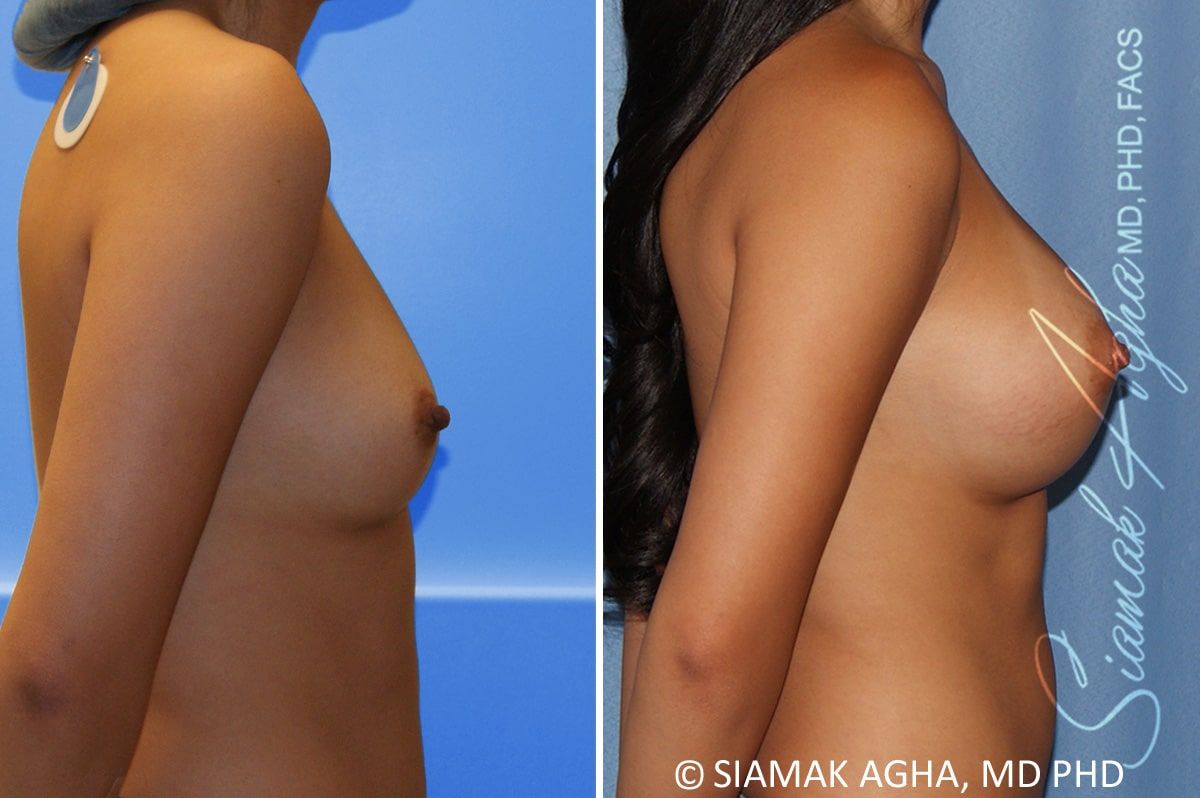 Breast Augmentation Before & After