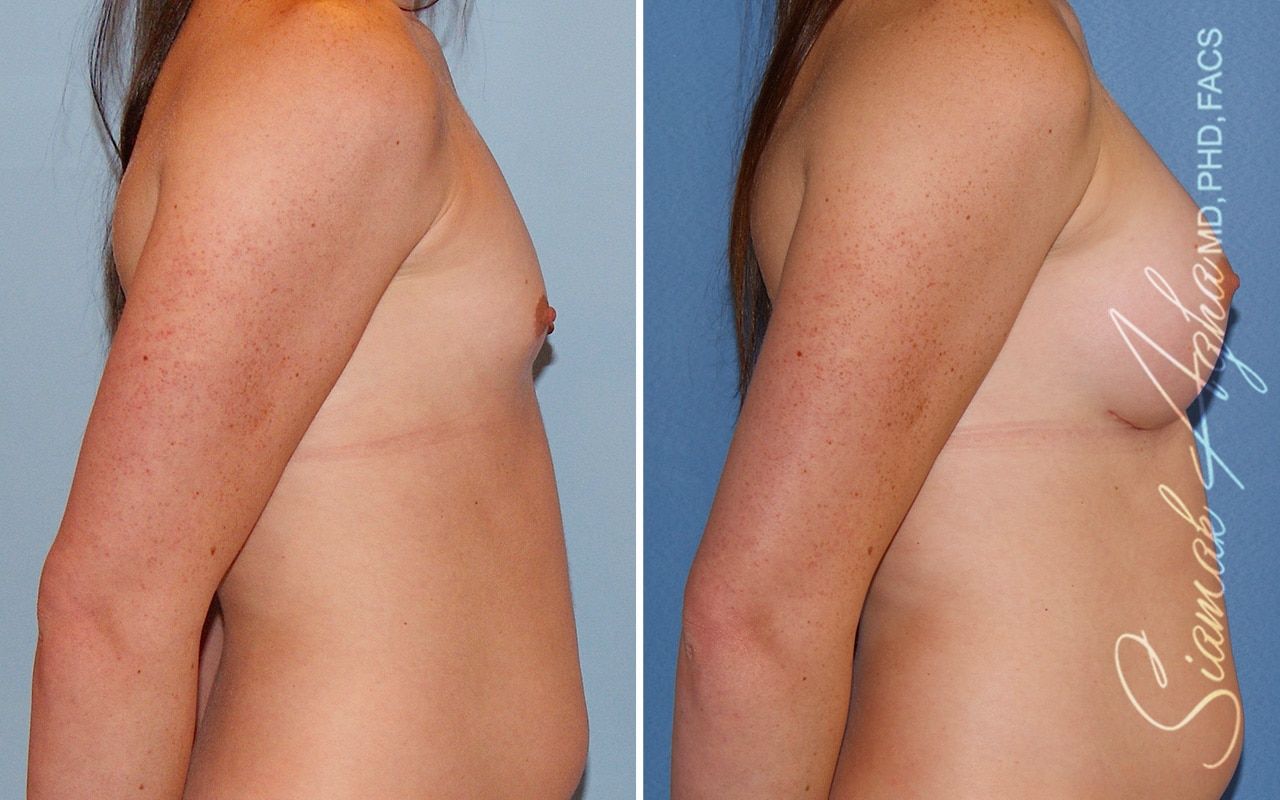 Breast Augmentation Before & After