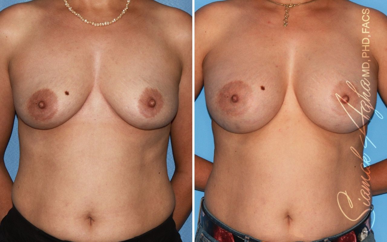 Breast Augmentation Before & After
