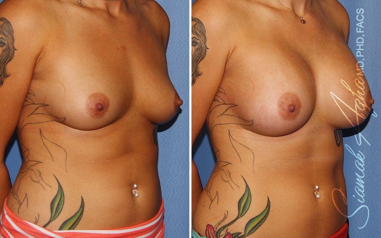 Breast Augmentation Before & After