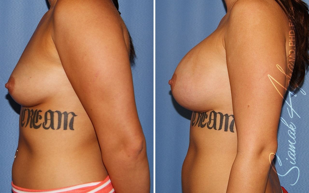 Breast Augmentation Before & After