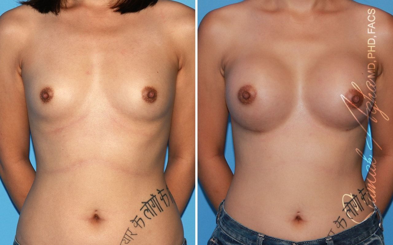 Breast Augmentation Before & After