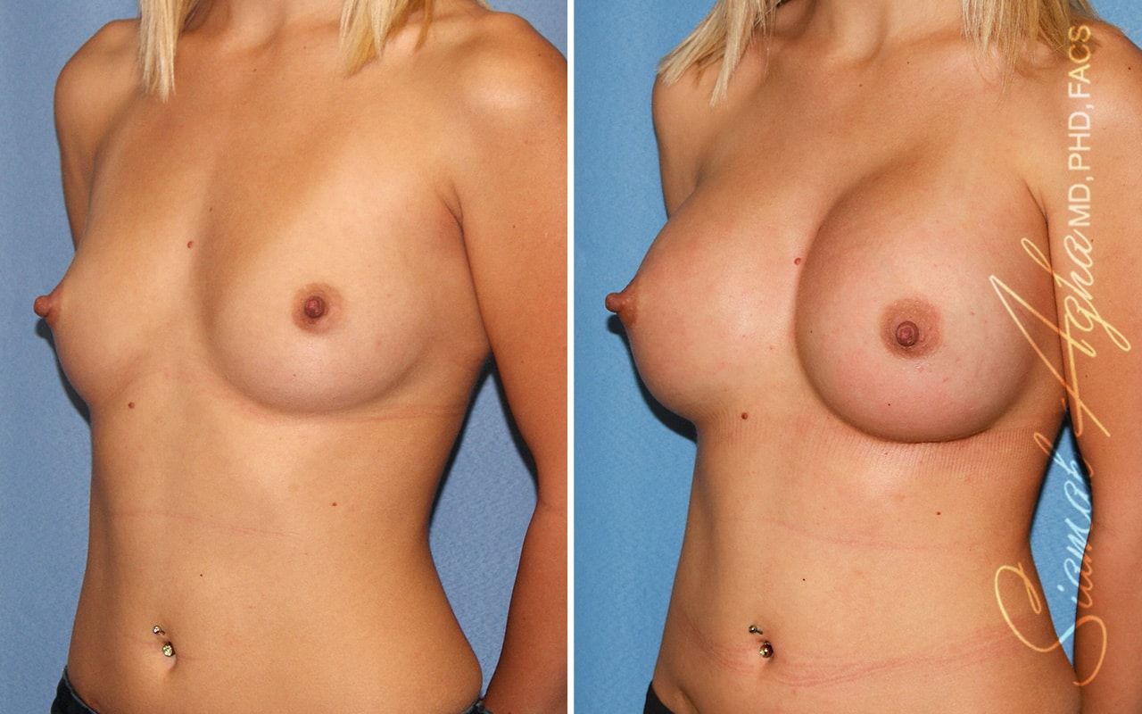 Breast Augmentation Before & After