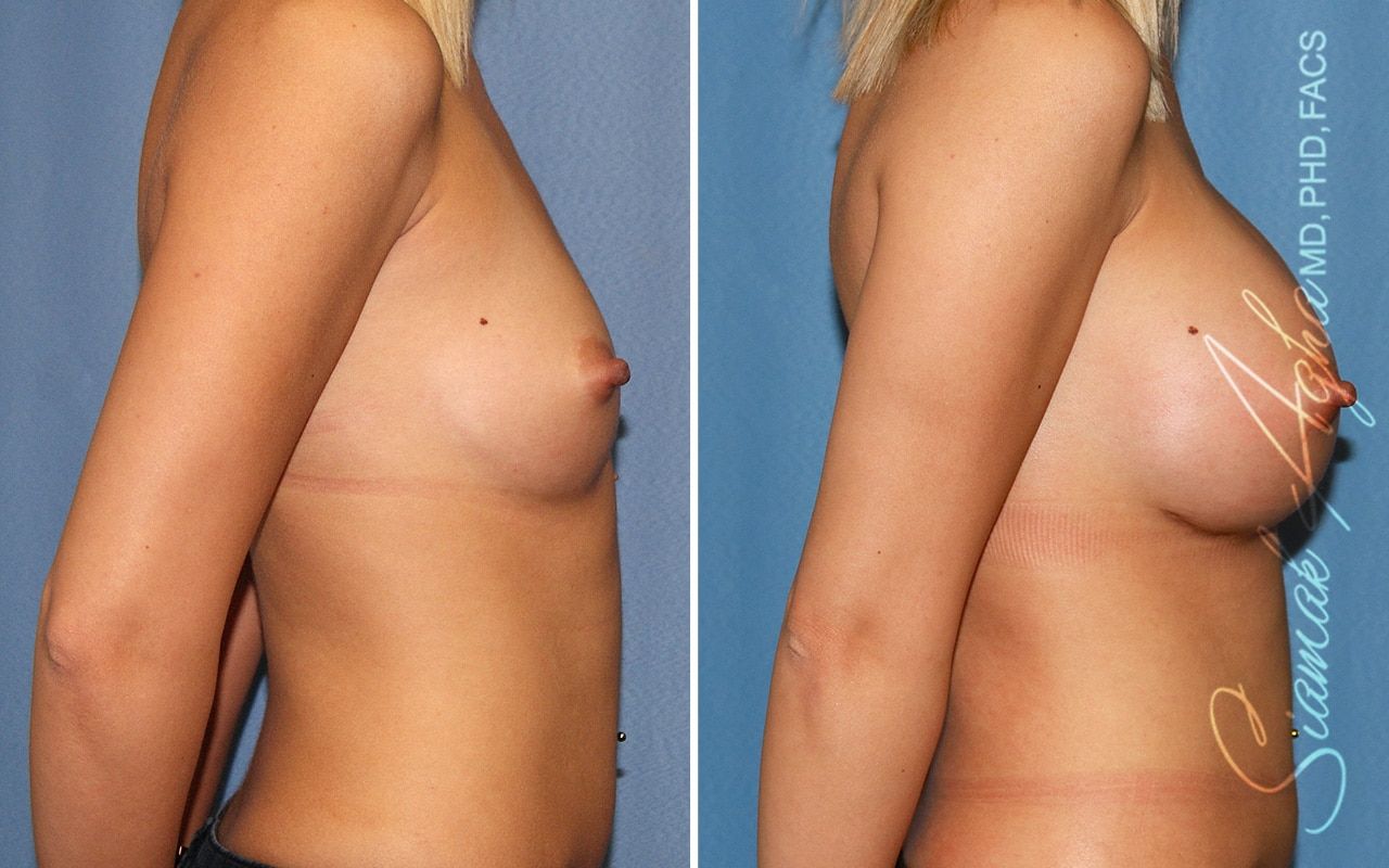 Breast Augmentation Before & After