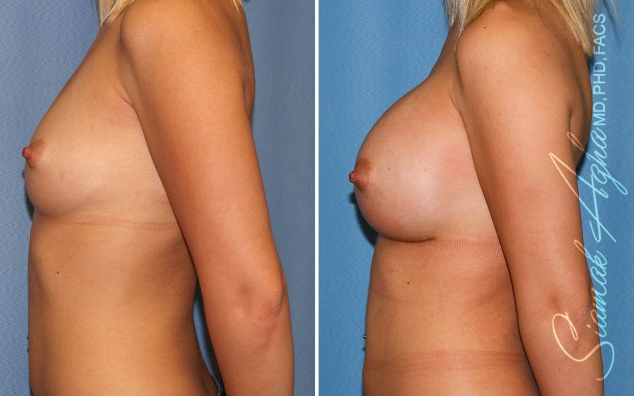 Breast Augmentation Before & After