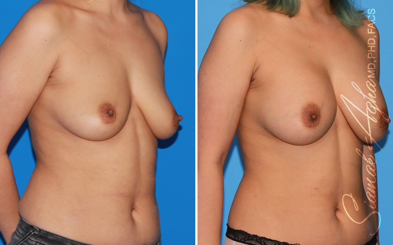 Breast Augmentation Before & After