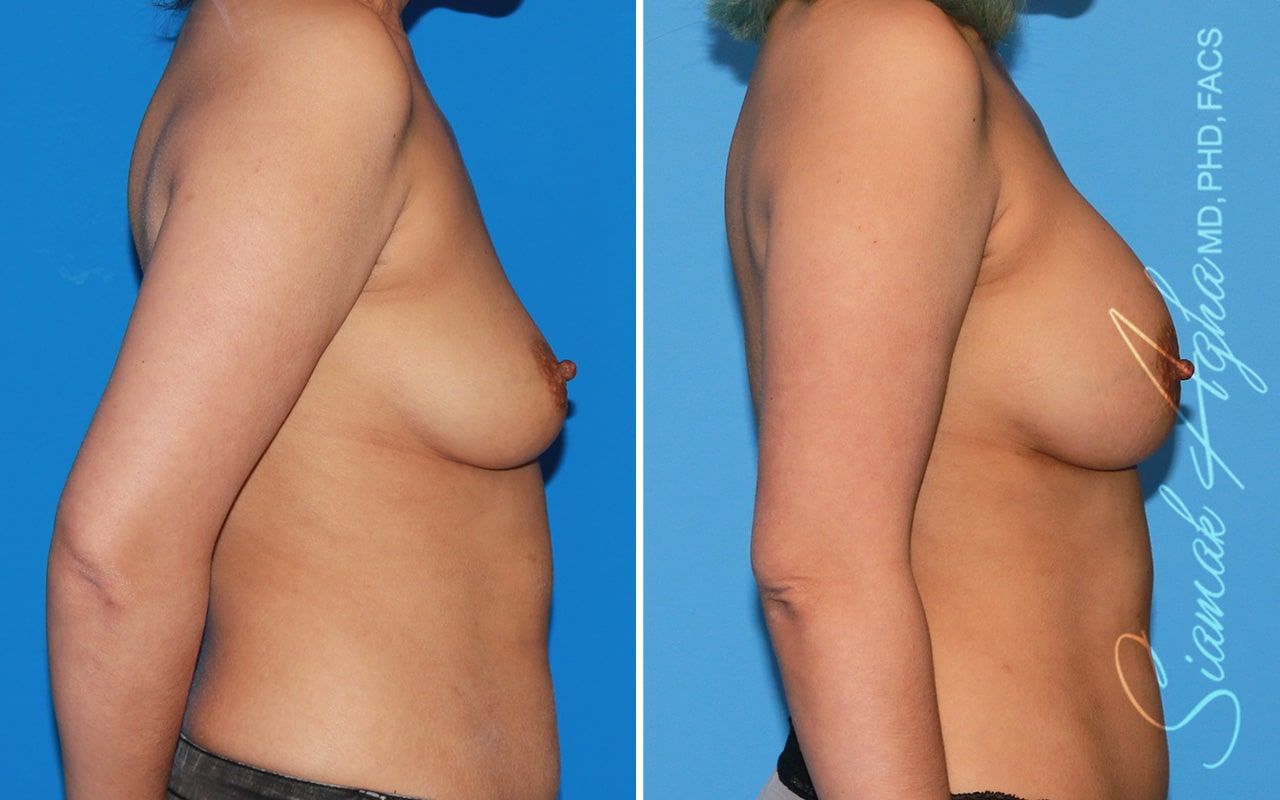 Breast Augmentation Before & After