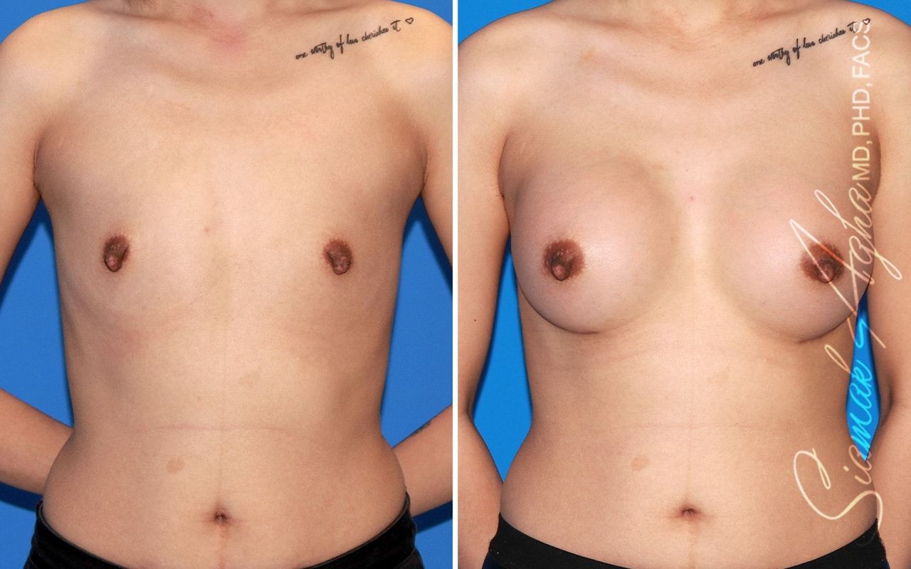 Breast Augmentation Before & After