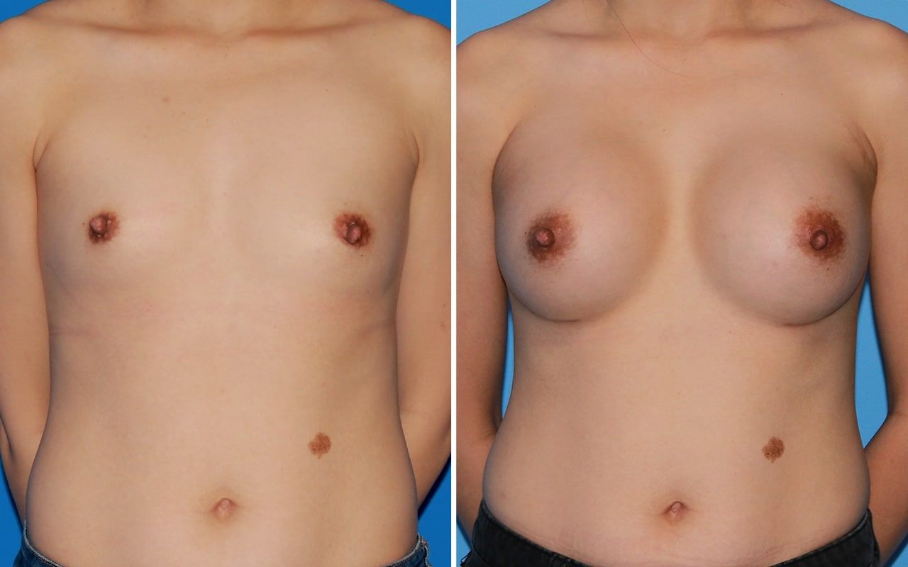 Breast Augmentation Before & After