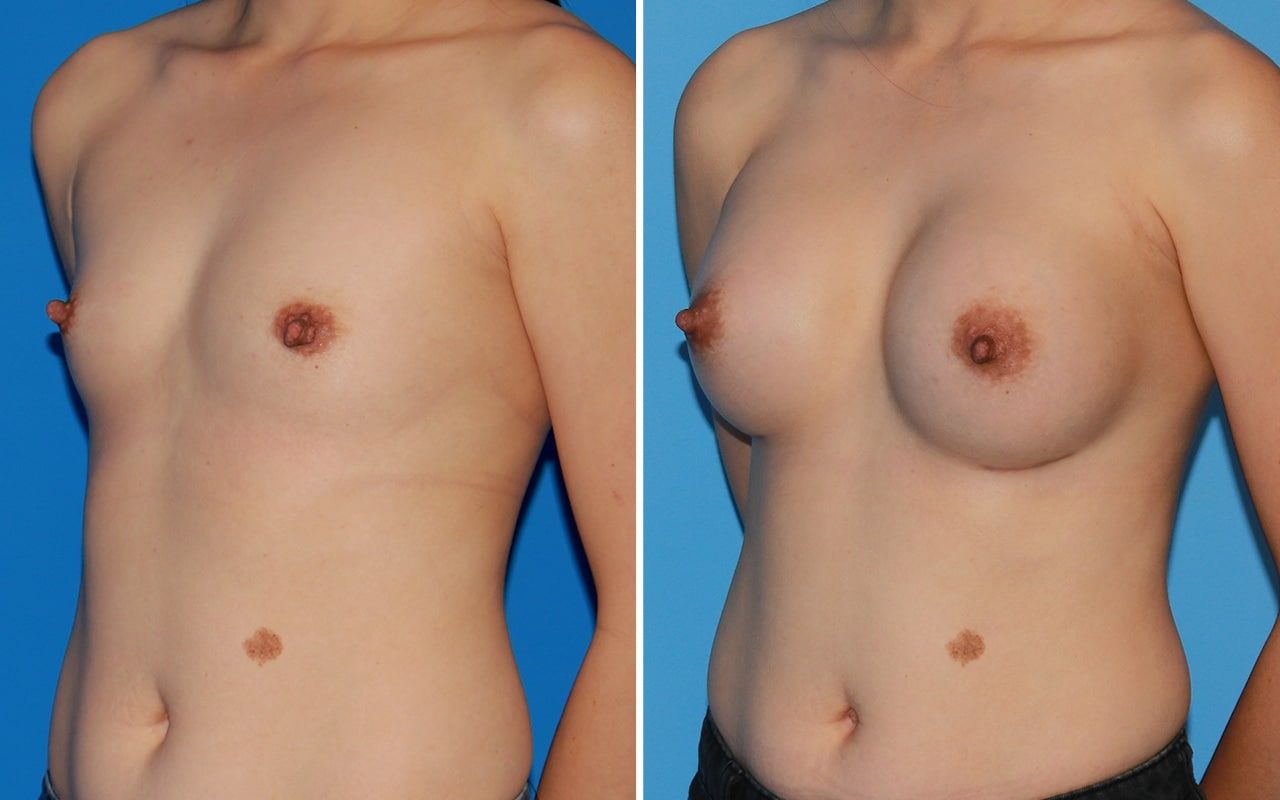 Breast Augmentation Before & After