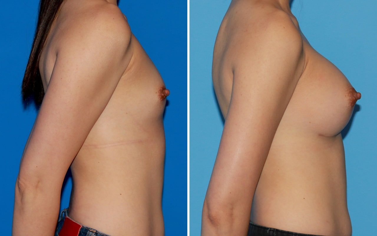 Breast Augmentation Before & After