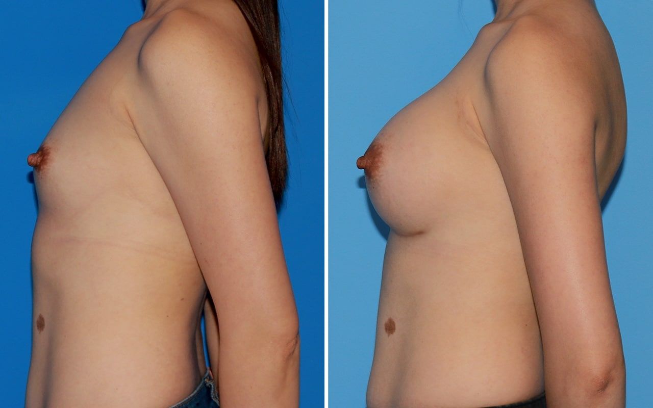 Breast Augmentation Before & After