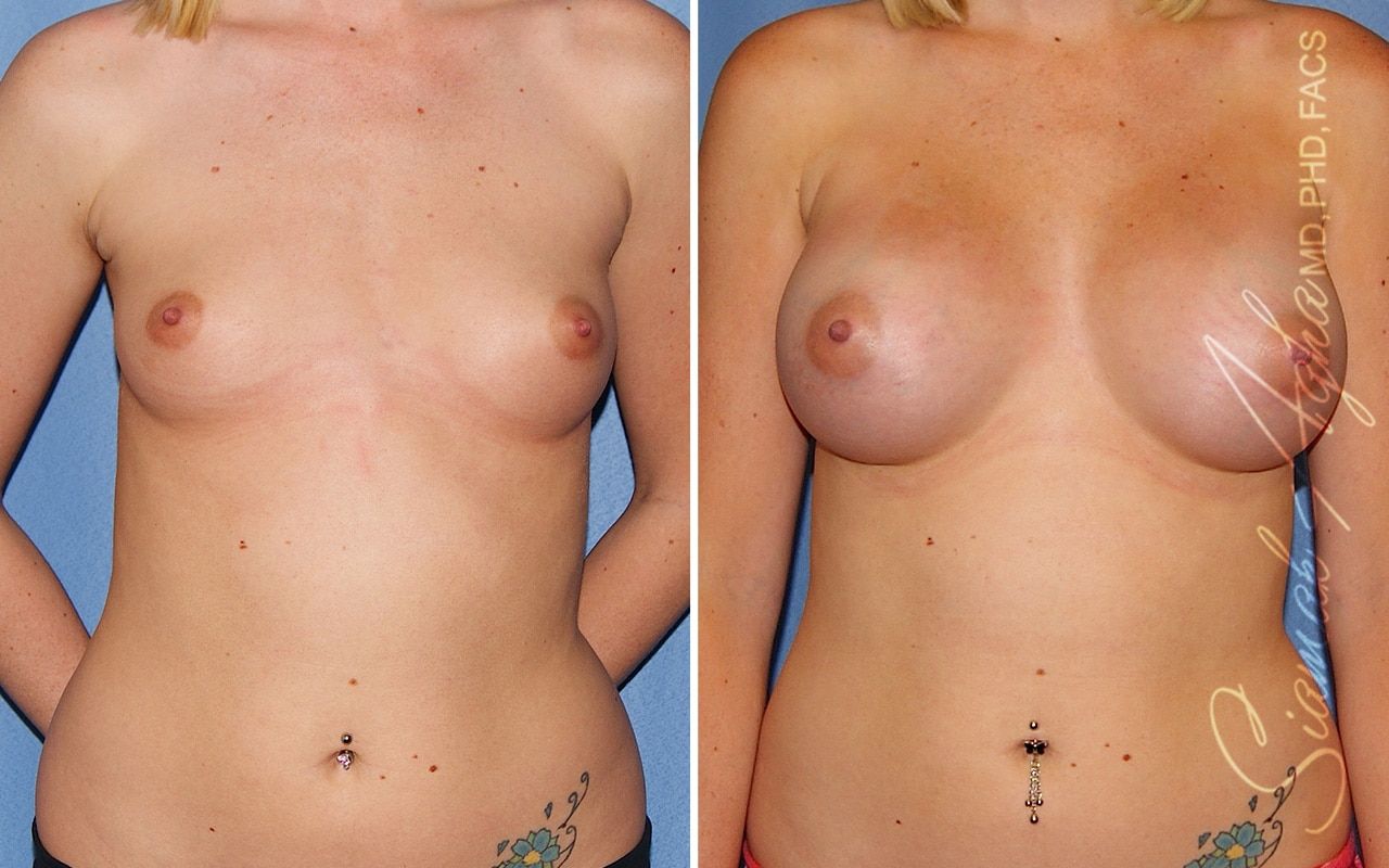 Breast Augmentation Before & After