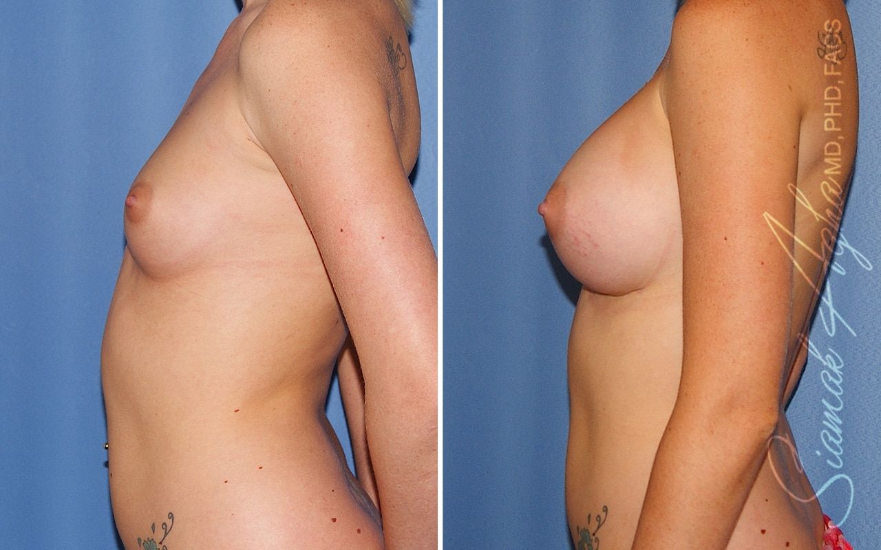 Breast Augmentation Before & After
