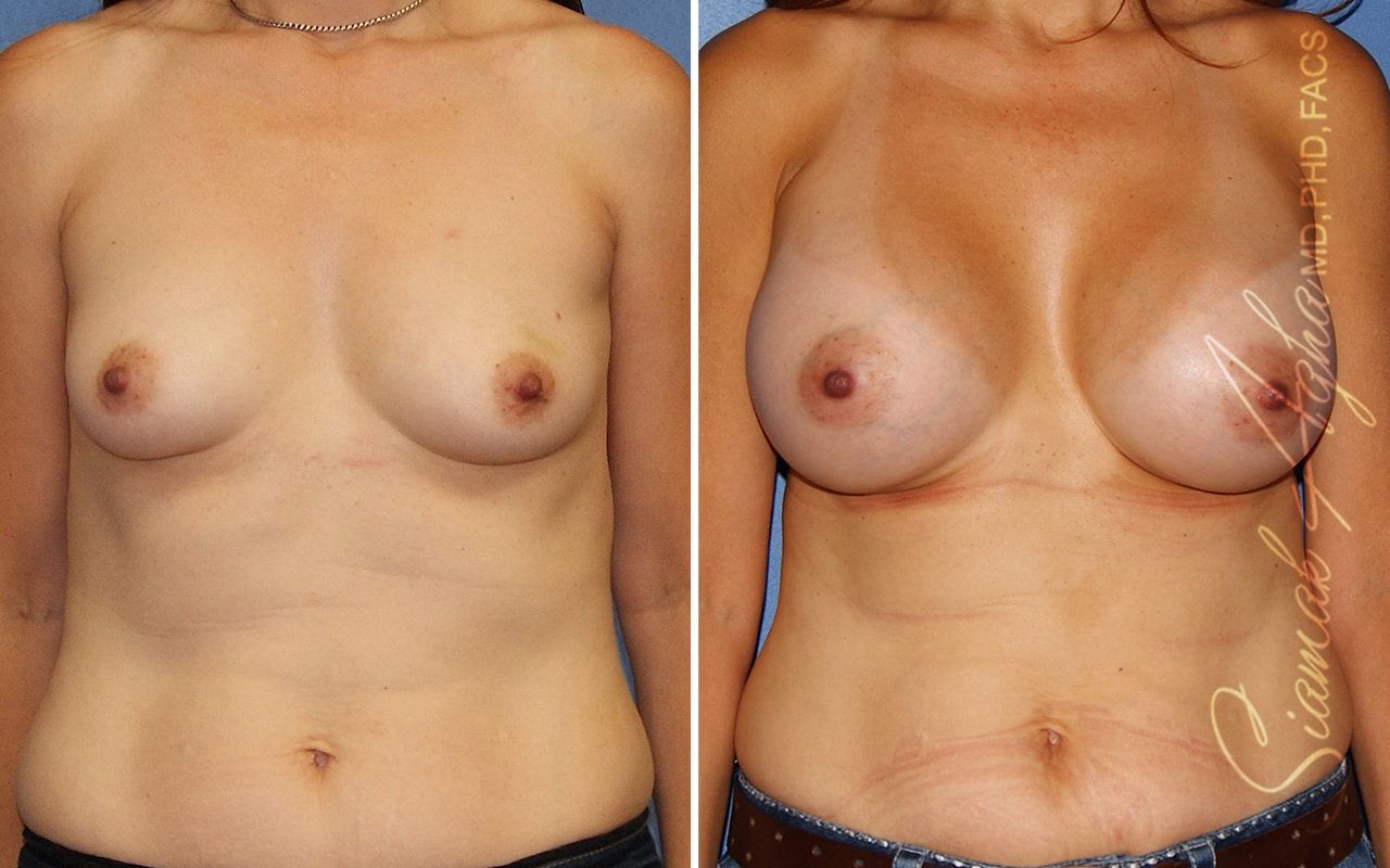 Breast Augmentation Before & After