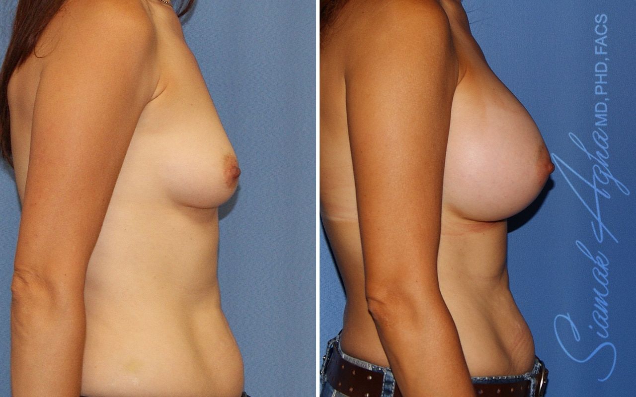 Breast Augmentation Before & After