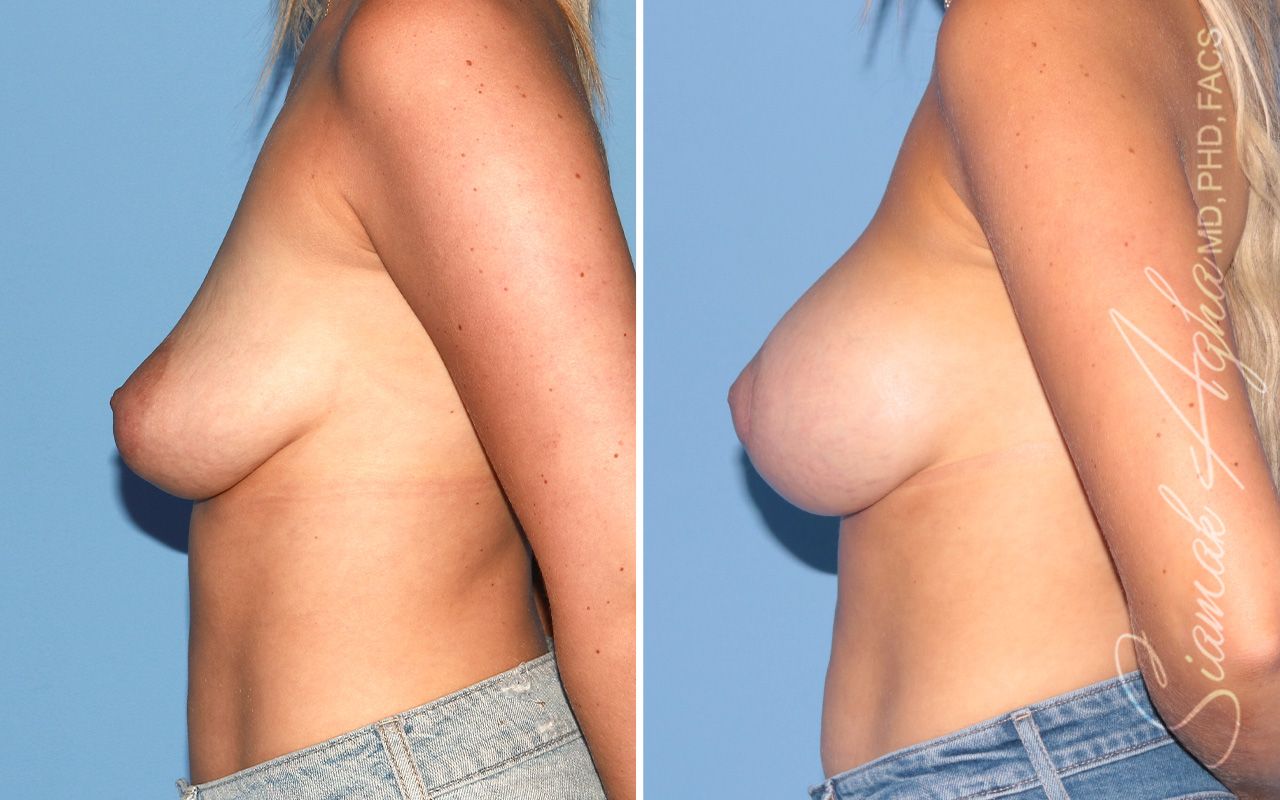Breast Augmentation Before & After