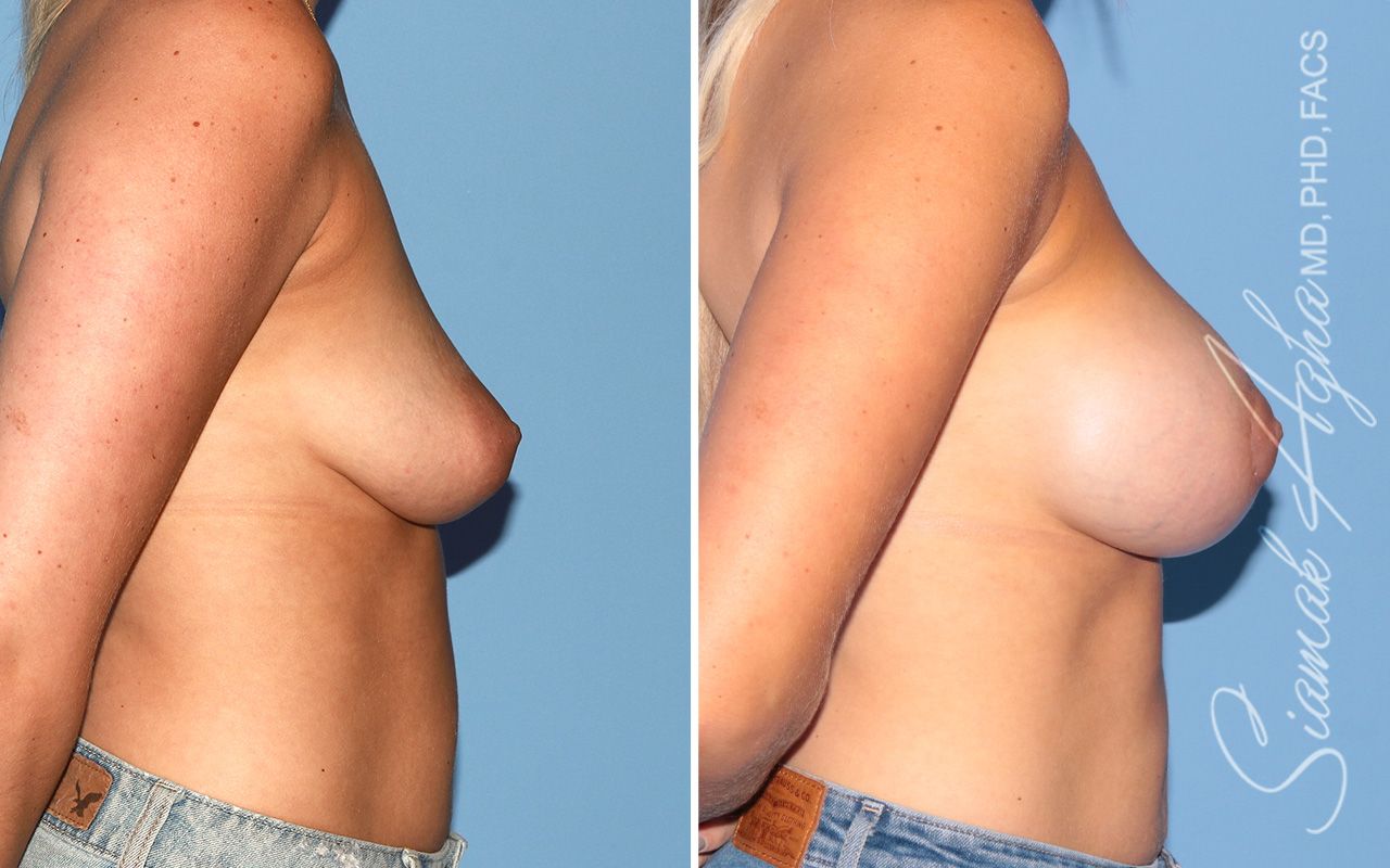Breast Augmentation Before & After