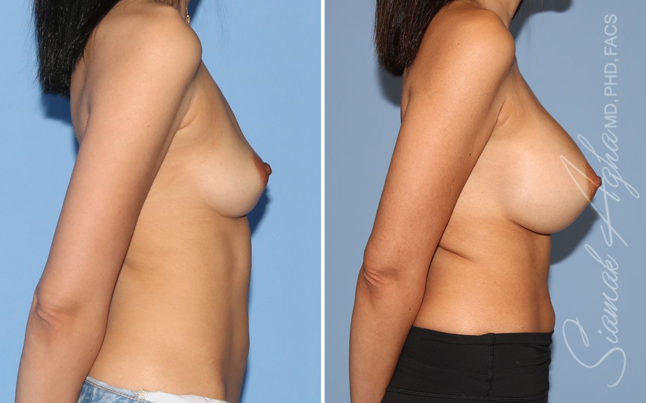 Breast Augmentation Before & After