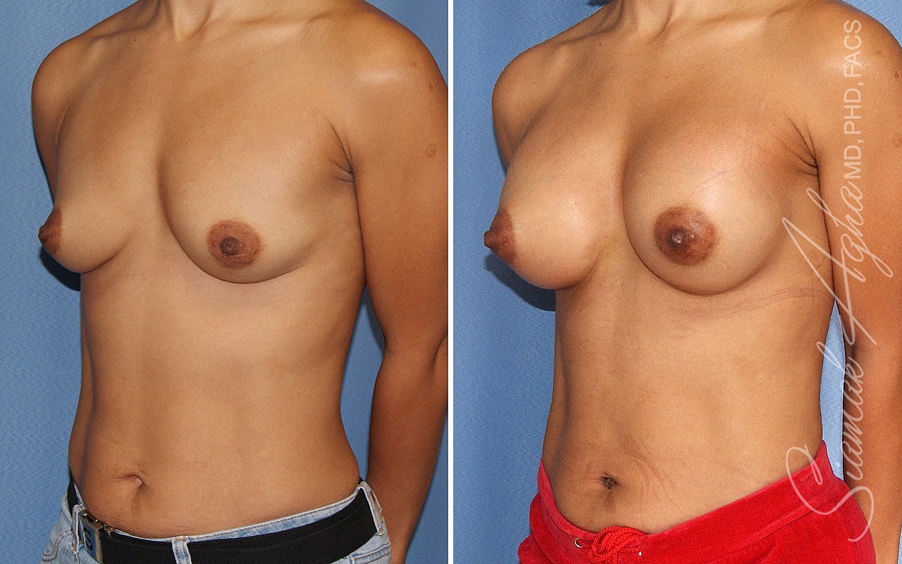 Breast Augmentation Before & After