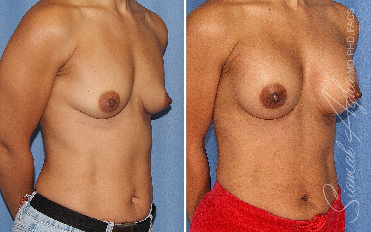 Breast Augmentation Before & After