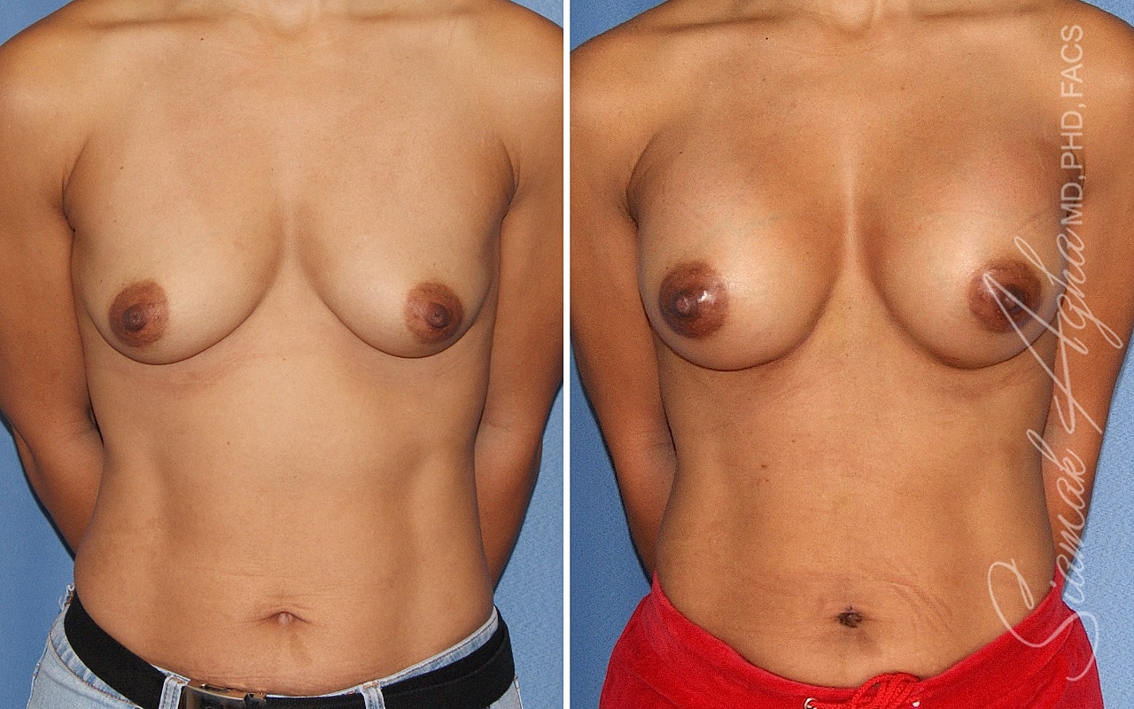 Breast Augmentation Before & After